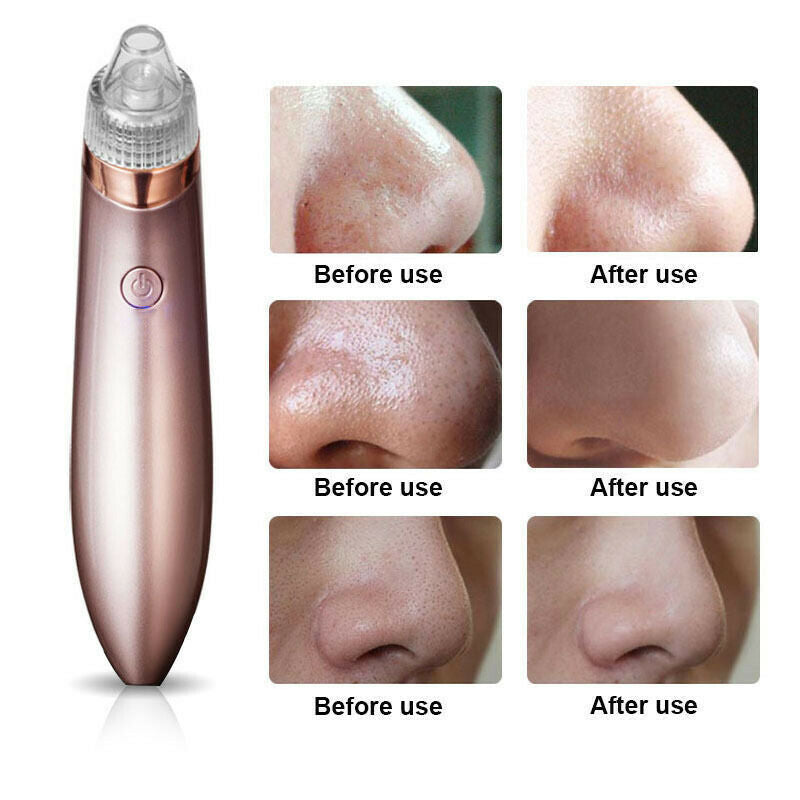 Electric Blackhead Remover – Strong Suction Pore Vacuum & Skin Cleaner